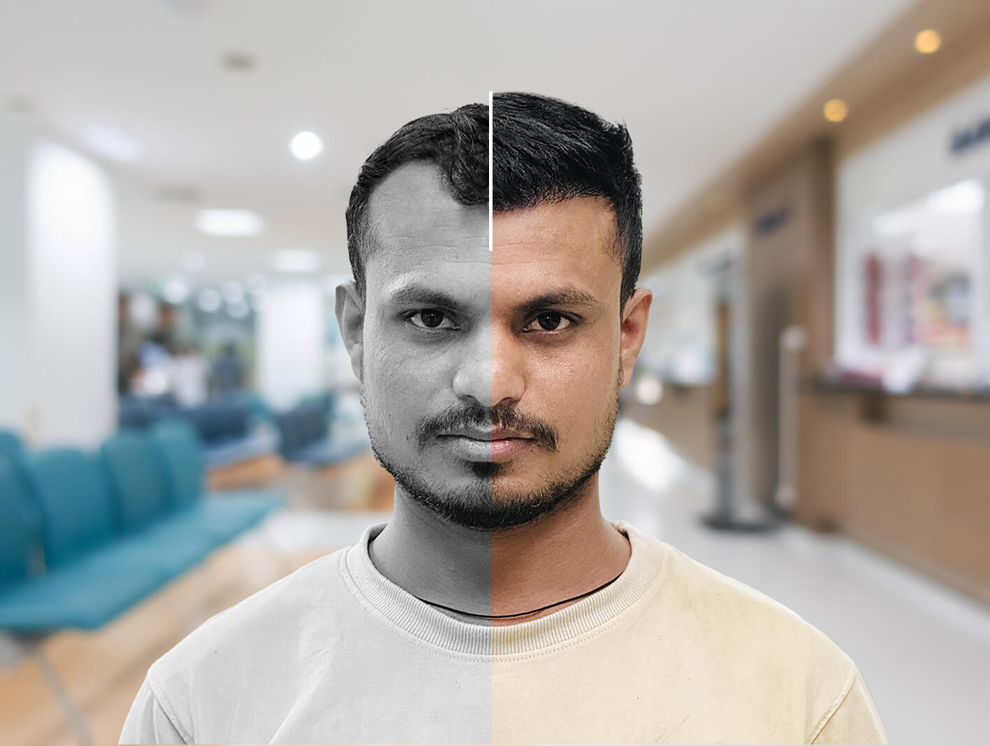Hairline transplant before after results